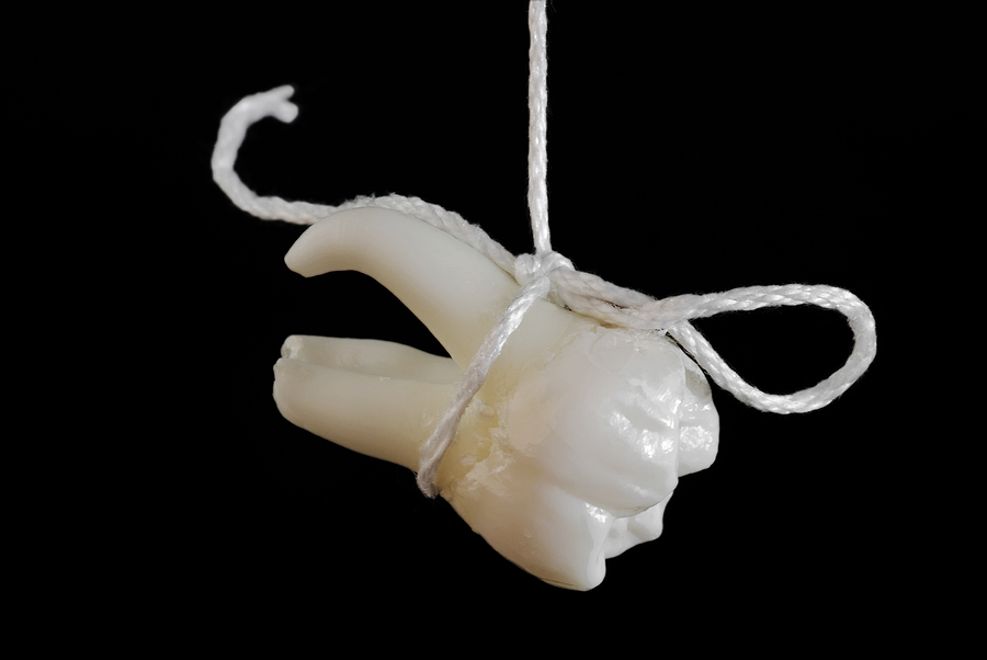 The Importance of Tooth Extraction in Preventing Oral Health Complications