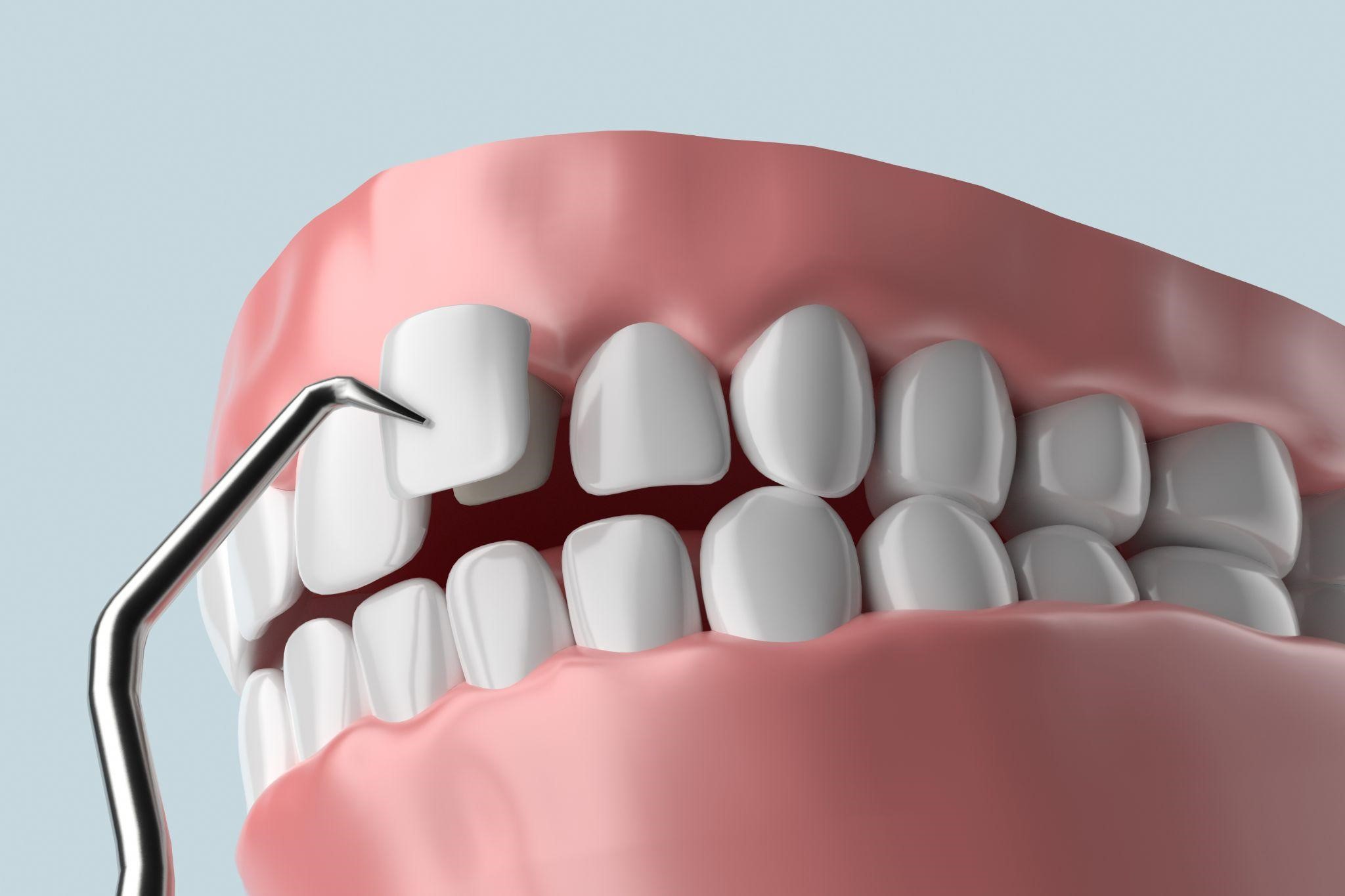 The Veneer Procedure