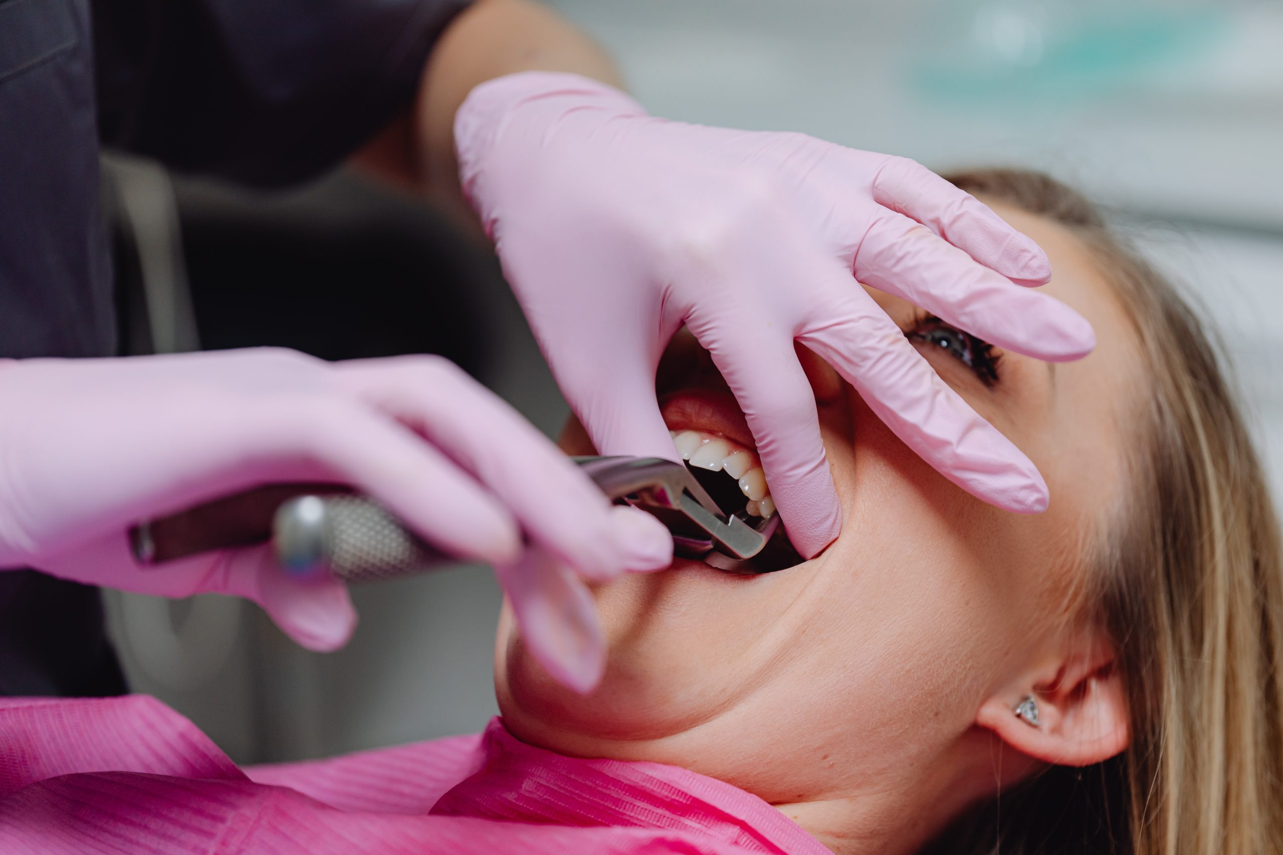 Reason for Teeth Extractions