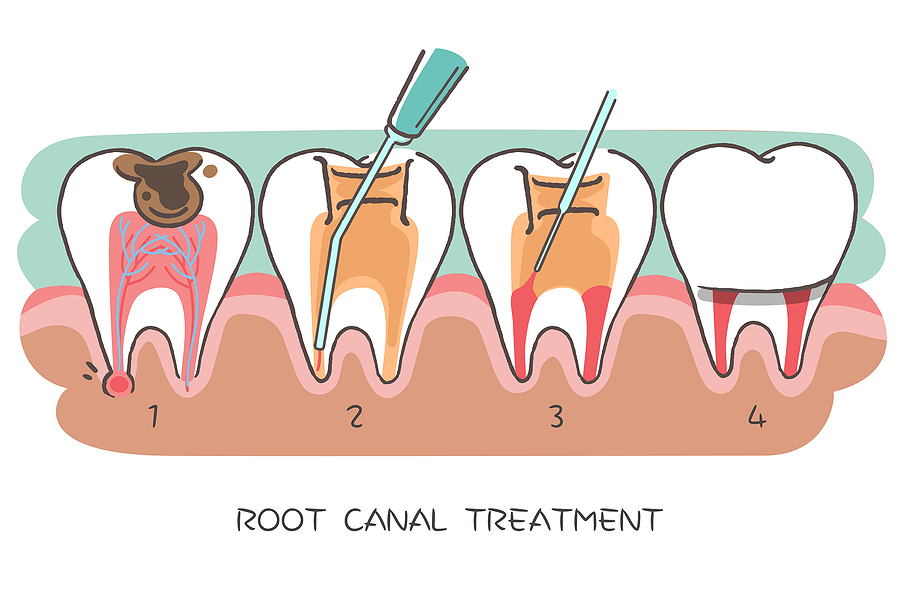 Understanding Root Canals: A Complete Guide to Saving Your Natural Teeth