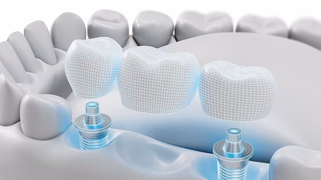 Dental implant bridge simulation
