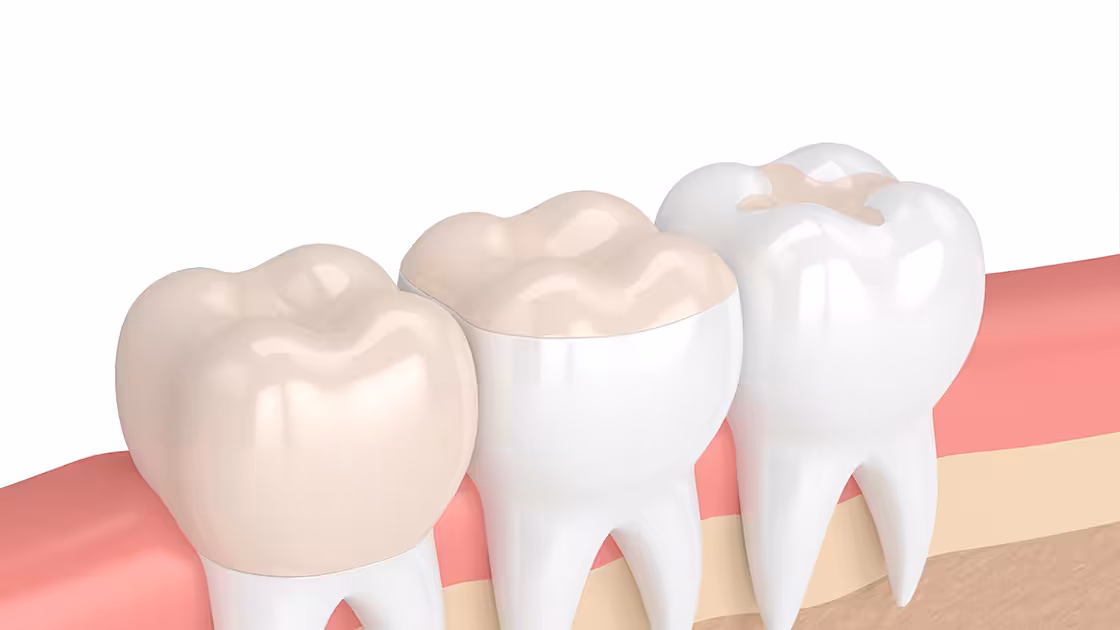Dental inlays onlays graphic